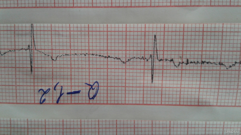 Плохая кардиограмма сердца у взрослого фото
